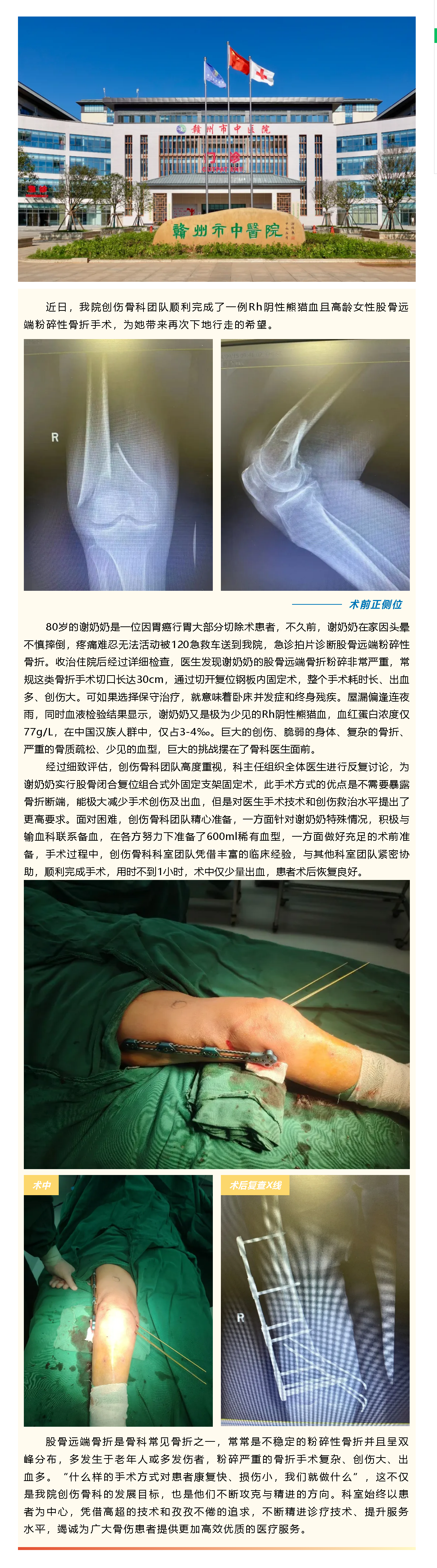 80歲粉碎性骨折阿婆竟是熊貓血，微創(chuàng)閉合復(fù)位破解創(chuàng)傷難題.png